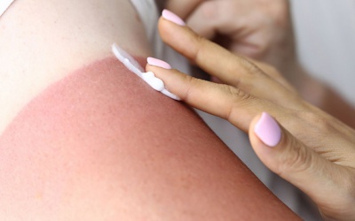 Da cháy nắng phải làm sao?