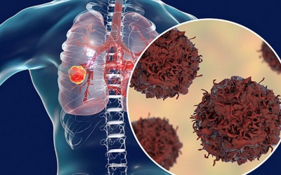 Tìm hiểu về ung thư phổi giai đoạn cuối