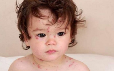 Trẻ bị thủy đậu kiêng gì nhanh khỏi bệnh?