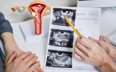 Những điều cần biết về bệnh lạc nội mạc tử cung