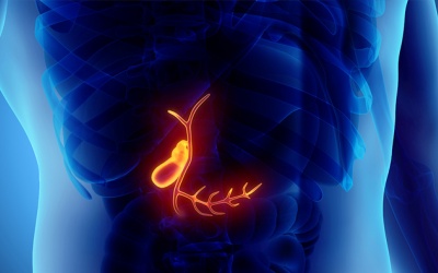 Hỏi - đáp về sỏi túi mật 22mm