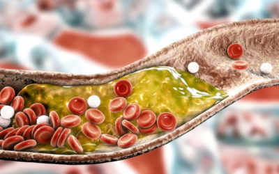 Những biến chứng nguy hiểm khi mắc bệnh mỡ máu cao