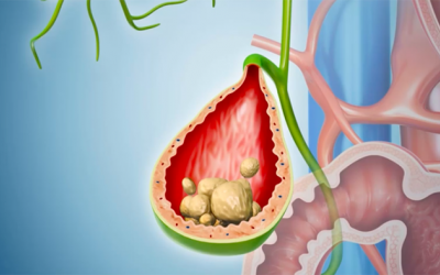 Một vài câu hỏi thường gặp về sỏi mật 3cm