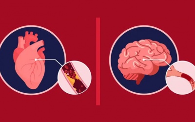 Tại sao rung nhĩ là bệnh tim nhưng có thể gây biến chứng lên não?