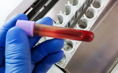 7 dấu hiệu cảnh báo sớm ung thư máu