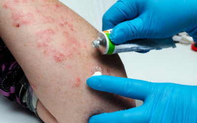 Lưu ý khi sử dụng thuốc điều trị bệnh vảy nến