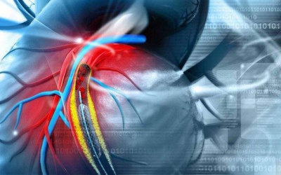 Mổ cầu nối động mạch vành, sau 3 tuần vẫn bị đau ngực nên làm gì?