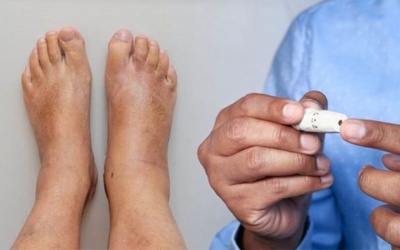 Đái tháo đường biến chứng khó ngủ, nóng rát đầu ngón chân điều trị thế nào?