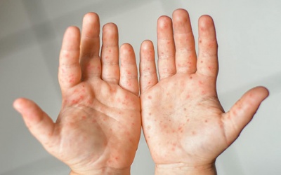 Nhiều trẻ mắc tay chân miệng trở nặng, nguy cơ thiếu thuốc đặc trị