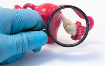 Tìm hiểu về phương pháp mổ u nang buồng trứng