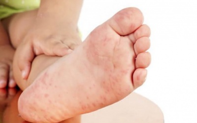 Ca mắc tay chân miệng tăng, Bộ Y tế yêu cầu siết chặt phòng chống dịch