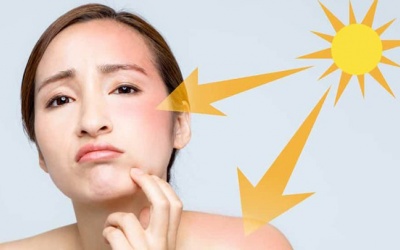 Mách bạn 4 bí quyết tránh sạm da trong mùa Hè