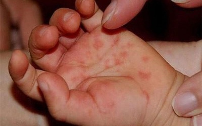 Bộ Y tế chỉ đạo khẩn tăng cường phòng, chống bệnh tay chân miệng