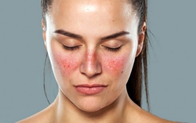 Không nên chủ quan với bệnh lupus ban đỏ