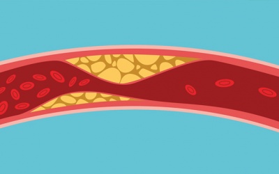 Tại sao chỉ số mỡ máu triglyceride của bạn tăng cao?