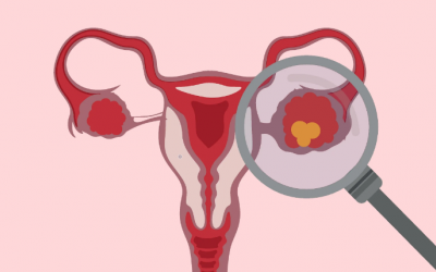 Phân loại u nang buồng trứng và cách cải thiện an toàn, hiệu quả