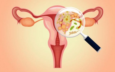Phát hiện vi khuẩn có thể kích thích lạc nội mạc tử cung