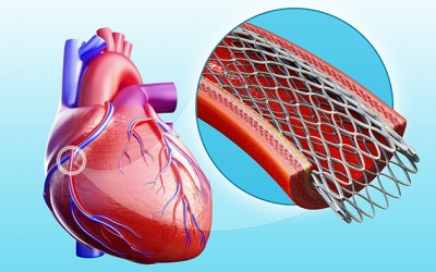 Chuyên gia giải đáp: Stent động mạch vành có tuổi thọ bao lâu?
