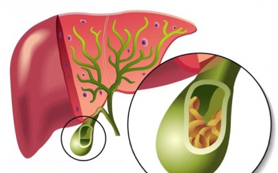 Mọi điều bạn cần biết về sỏi mật 18mm