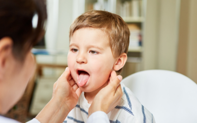 Lưu ý phòng viêm họng cho trẻ trong mùa Hè