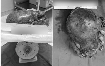 Người đàn ông phát hiện khối u tăng 5,5kg chỉ sau 5 tháng