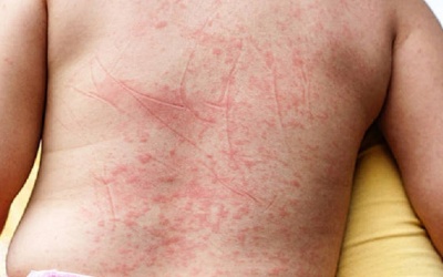 Gia tăng số ca sốt xuất huyết có dấu hiệu cảnh báo ngay từ đầu mùa dịch