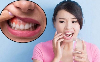 Bật mí cách phòng ngừa viêm quanh răng hiệu quả 