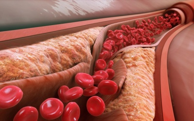 Mạch vành tắc 50%, cần làm gì để tránh phẫu thuật sau này?