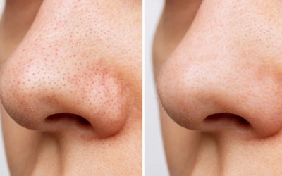 Cách khắc phục lỗ chân lông trên da
