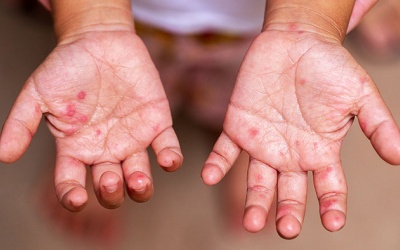 Những điều cha mẹ cần biết khi chăm sóc con bị tay chân miệng