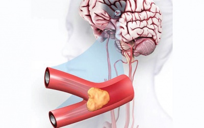 Tắc nghẽn mạch máu não: Làm thế nào để hồi phục?