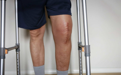 Lợi ích của giảm cân trước khi phẫu thuật thay khớp