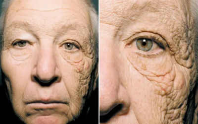 Hai nửa khuôn mặt khác biệt sau 28 năm tiếp xúc với ánh nắng mặt trời