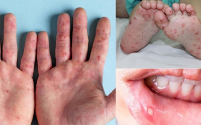 Cách phân biệt phỏng nước do tay chân miệng với thủy đậu