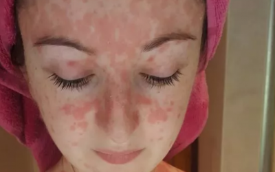 Cách kiểm soát bệnh vảy nến ở mặt