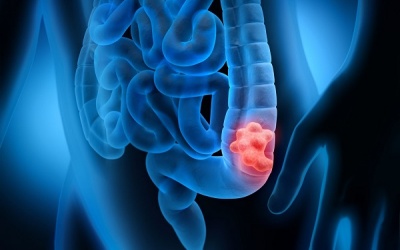 Phát hiện ung thư trực tràng sau 1 năm rối loạn tiêu hóa không đi khám