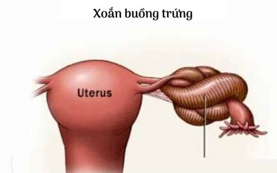 Xoắn hoại tử buồng trứng: Cẩn thận chẩn đoán nhầm
