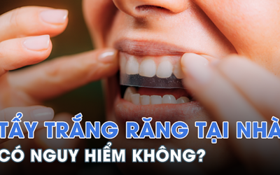 Hậu quả của việc tự ý tẩy trắng răng tại nhà