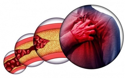 Chiến lược kiểm soát mỡ máu cao an toàn, hiệu quả