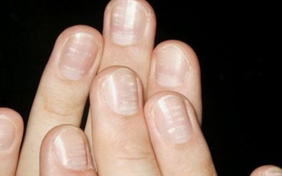 Mách bạn cách phân biệt vảy nến móng tay và nấm móng tay