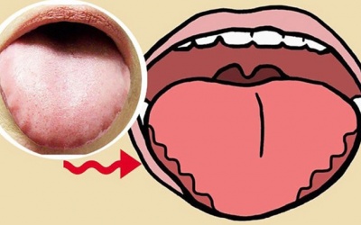 Dấu hiệu trên lưỡi cảnh báo bạn đang thiếu vitamin B12