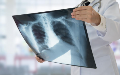 Lượng vitamin K thấp khiến chức năng phổi kém