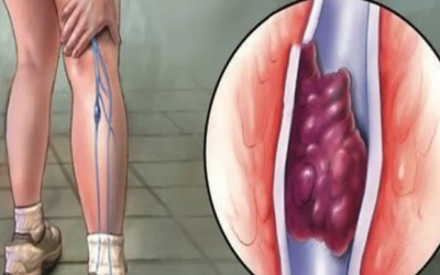 3 cách ngăn ngừa hình thành cục máu đông ở chân