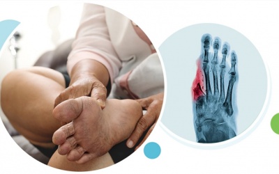 Cách phòng ngừa biến chứng bàn chân cho người bệnh đái tháo đường