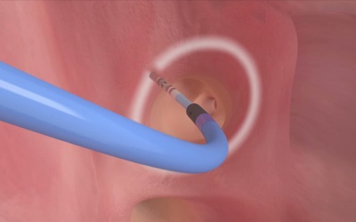 Tại sao không nên đốt điện tim sớm điều trị ngoại tâm thu?