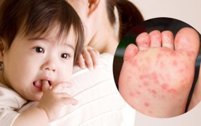 Cha mẹ cần lưu ý gì khi chăm sóc trẻ tay chân miệng?