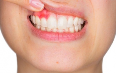 Cách điều trị và phòng viêm lợi tái phát thế nào?