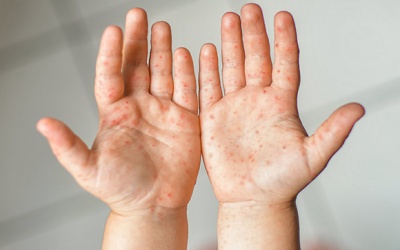 Cả nước đã ghi nhận gần 70.000 ca mắc tay chân miệng