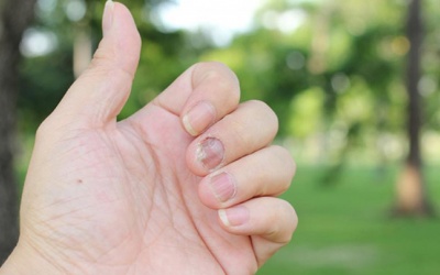 Triệu chứng vảy nến móng tay qua từng giai đoạn