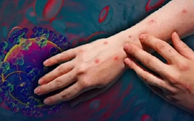 Thái Lan tăng đột biến số ca mắc đậu mùa khỉ ở thanh thiếu niên